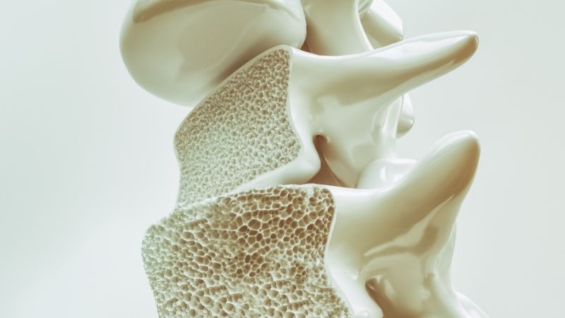 ossos   osteoporose